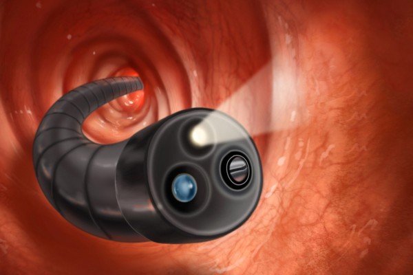 1800x1200 what to expect with a colonoscopy slideshow